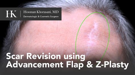 Forehead Scar Revision Using Advancement Flap And Z Plasty Dr Hooman