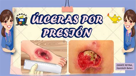 Top 164 Imagen Ulceras Por Presion Dibujos Expoproveedorindustrial Mx