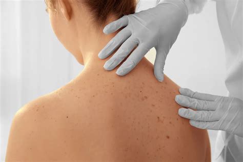 Dermatologia jakie choroby najczęściej leczy dermatolog Stolica