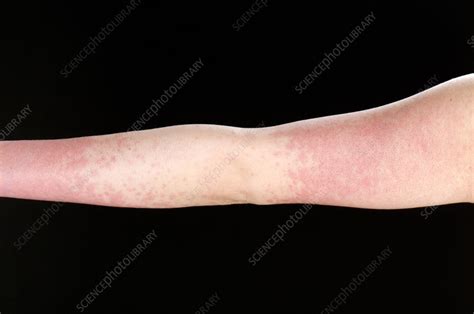 Amoxicillin Ebv Rash