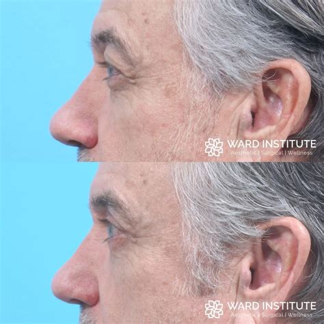 Blepharoplasty Before And After Photo Patient 05 Ward Institute