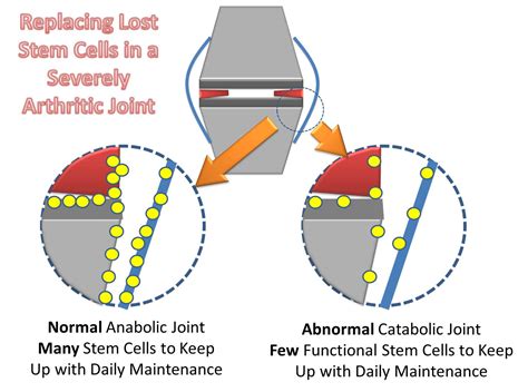 How Does A Stem Cell Arthritis Injection Work In A Severe Arthritis