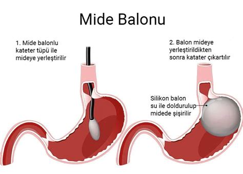 Mide balonu sonrası bulantı kusma olur mu