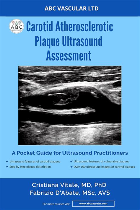 Carotid Atherosclerotic Plaque Ultrasound Assessment A Pocket Guide For Ultrasound