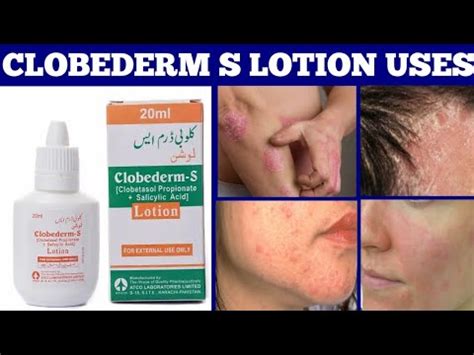 Clobederm S Lotion Uses In Urdu Clobederm S Lotion Benefits Eczema