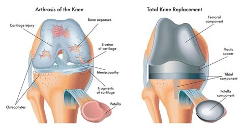 Telemedica Va Disability Rating For Knee Replacements