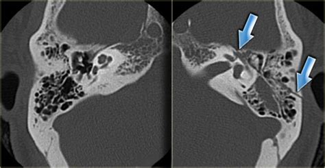 The Radiology Assistant : Temporal Bone Pathology