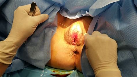 Labiaplasty Labia Fusion In Lichen Sclerosis Youtube