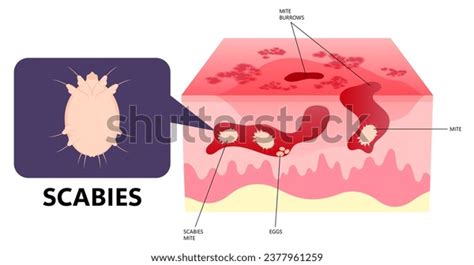 Eczema Dermatitis Skin Red Itching Stock Vector (Royalty Free ...