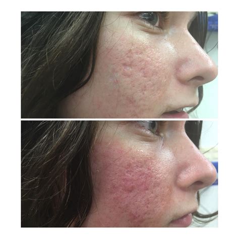 Az ég Képes ellenállni vég co2 laser reviews acne scars miért ne Vakol