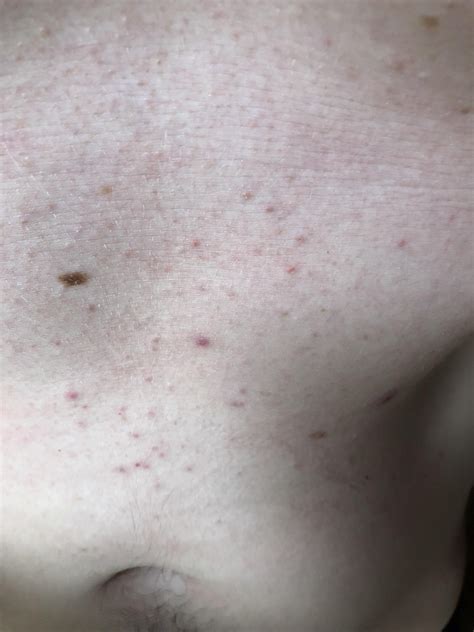 32 M Is This Acne Stomach Photo Of Bumps That Have Been Around For