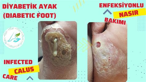 D Yabet K Ayak Bakimi Enfeks Yonlu Nasir Bakimi Diabetic Foot Care