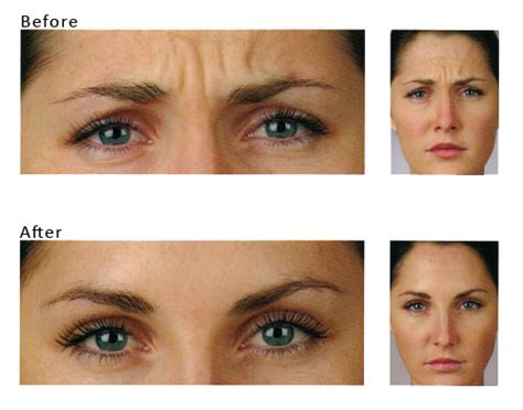 Wrinkle Free? Botox Before and After Photos