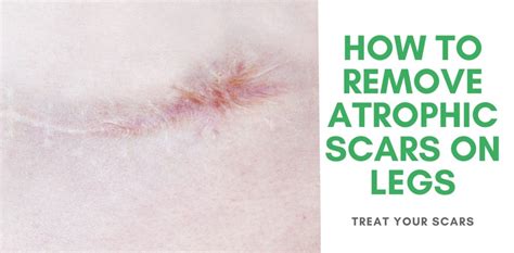 How To Remove Atrophic Scars On Legs Treat Your Scars