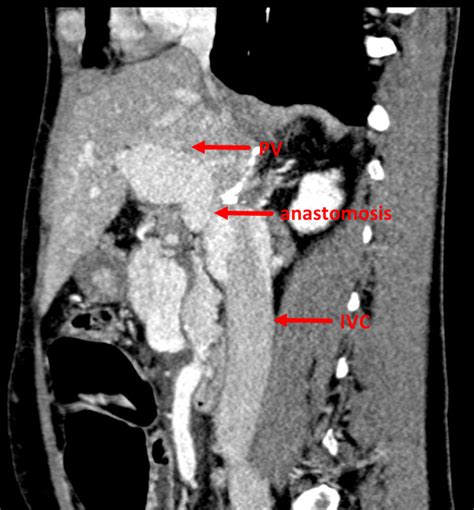 Establishing Portal Inflow With Diffuse Splanchnic Venous Thrombosis