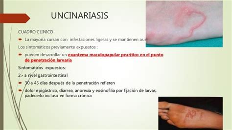 Uncinariasis