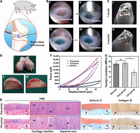 Evaluation Of Water Filled Arthroscopic Aci Treatment Based On Hpc