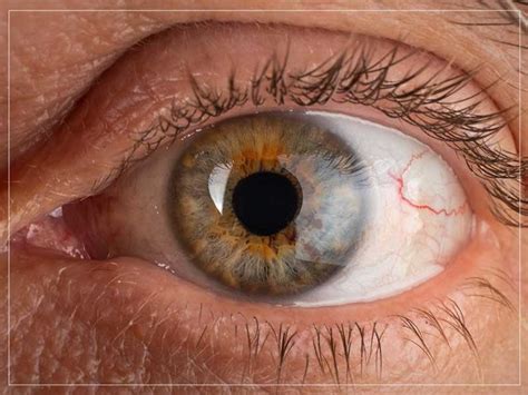 All About Keratoconus Causes Symptoms And Treatments