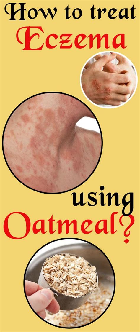 Will Taking Avena Sativa Oat Complex Orally Help With Eczema