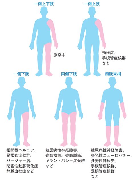 『手足のしびれ・痛み』 日本臨床内科医会