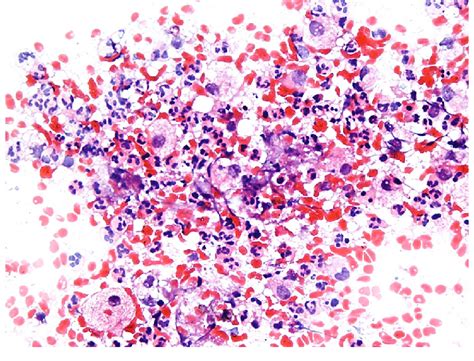 Dense Neutrophilic Infiltrate Along With Macrophages Seen In A Case Of