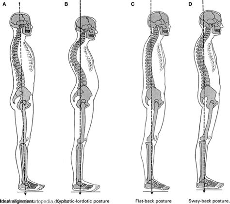 Postura Kendall Traumatologia E Ortopedia