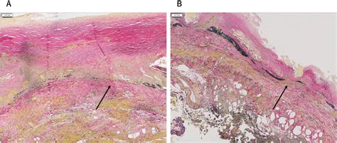 Elastica Van Gieson Evg Staining Revealed A Decrease And