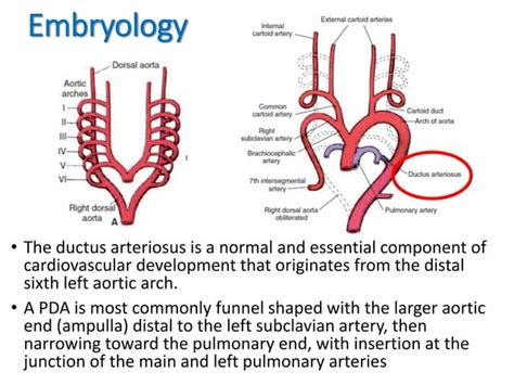 Patent Ductus Arteriosus Pda