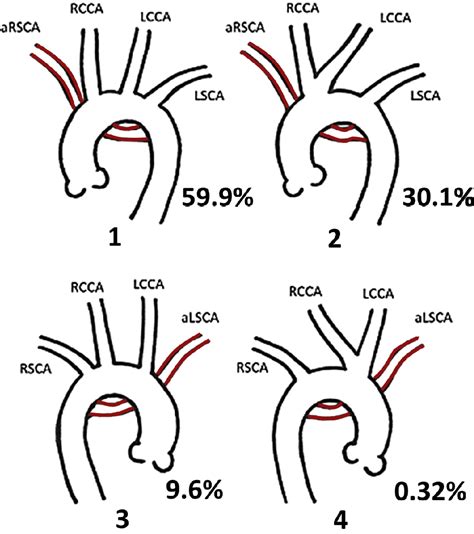 Association Of Aberrant Subclavian Arteries With Aortic Pathology And