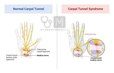 Tinels Sign – My Endo Consult