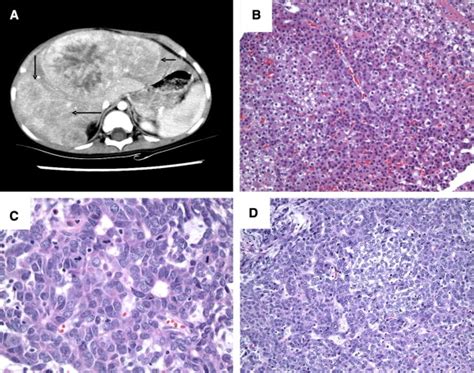 Analysis Of National And Single Center Incidence And Survival After Liver Transplantation For