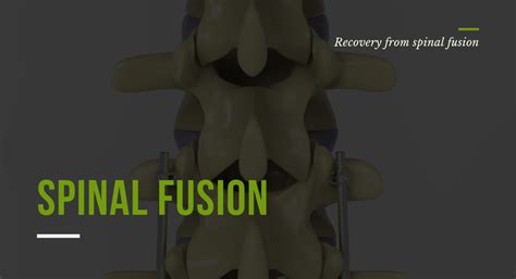 Recovery from spinal fusion