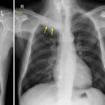 Pancoast tumour - CT/MRI - Radiology at St. Vincent's University Hospital