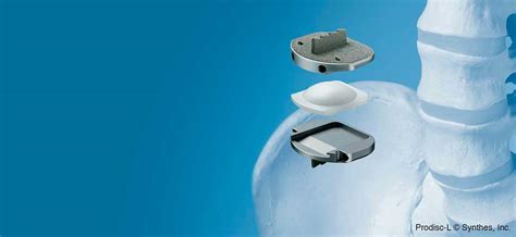 artificial disc replacement cost centers