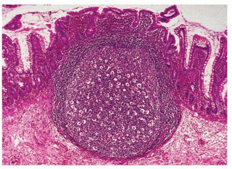 Small Bowel Mucosal Disease Abdominal Key