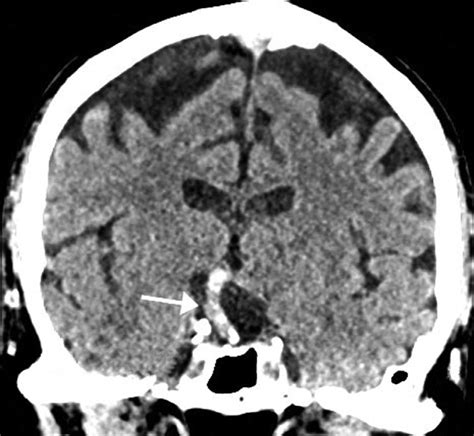 -Computerized tomography shows basilar artery occlusion in coronal and... | Download Scientific ...