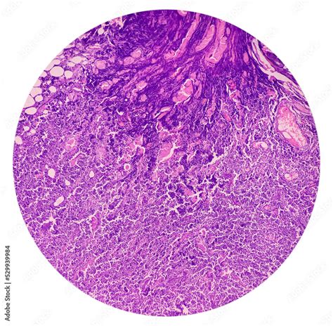 Supraclavicular lymph node biopsy: Microscopic image showing benign ...