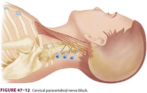 Cervical Paravertebral Nerve Blocks