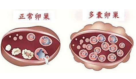 什么是多囊卵巢综合征 多囊有什么危害 怎么检查治疗