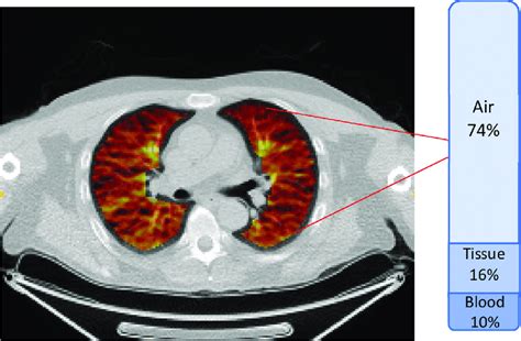 Example Of A Fused F Fdg Pet Ct Lung Scan The Typical Proportions