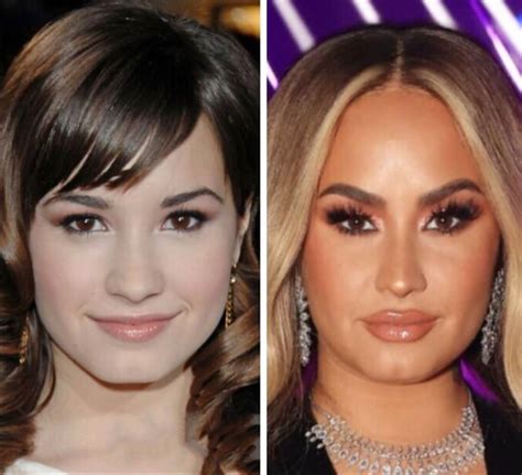 Demi Lovato Celebrity Surgery Celebrity Plastic Surgery Spring