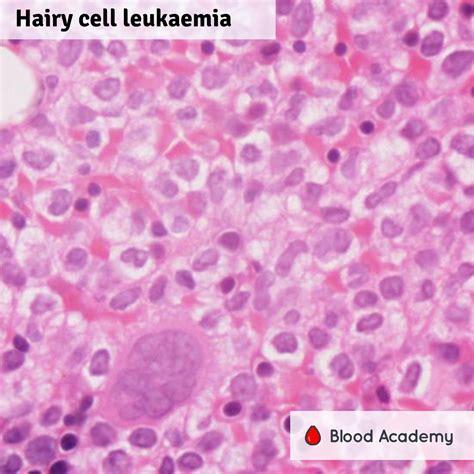 Blood Academy On Twitter Hairy Cell Leukaemia Bone Marrow