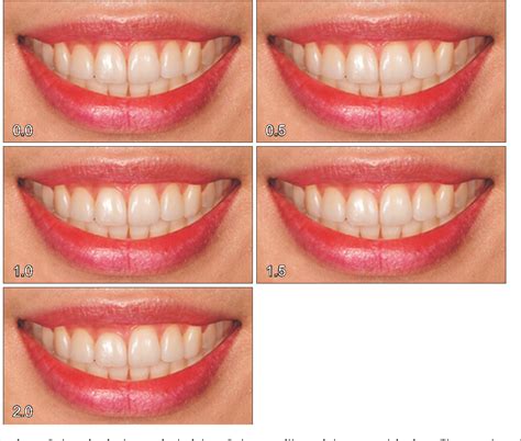 Figure 2 From Comparing Esthetic Smile Perceptions Among Laypersons With And Without Orthodontic