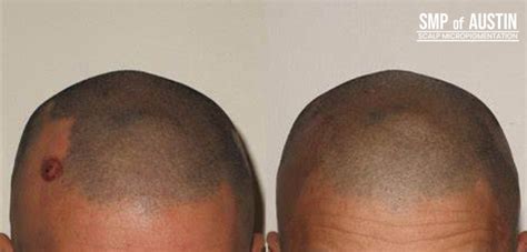 Micropigmentation For Scalps Has Many Benefits Smp Of Austin