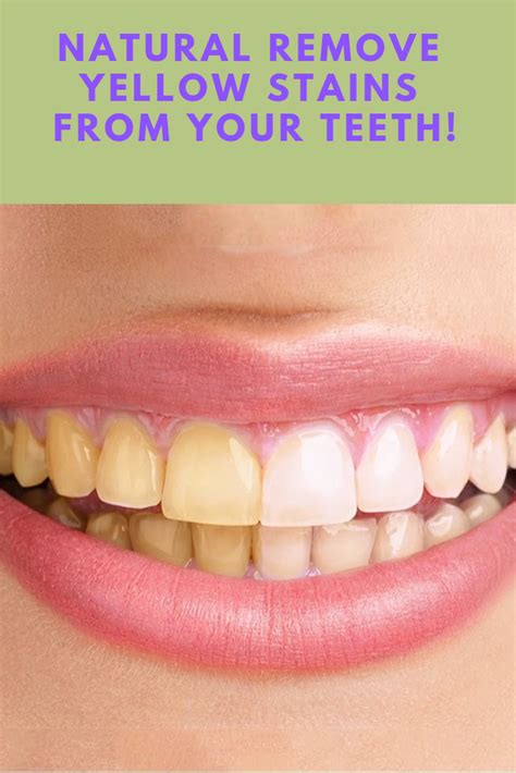 Famous How To Remove Stains From Teeth Instantly