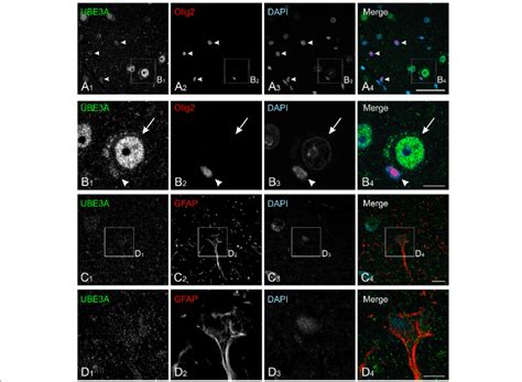 UBE3A Expression In Neuroglia In Temporal Cortex From Human Biopsy