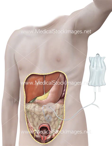 Peritoneal Dialysis Procedure – Medical Stock Images Company