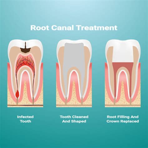 Root Canal Treatment Calla Dental And Cosmetic Clinic