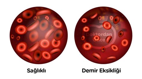 Demir Eksikli I Nedir Sebepleri Nelerdir Doktordan Nce