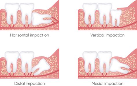 Wisdom Teeth Removal Neutral Bay Elite Dentistry